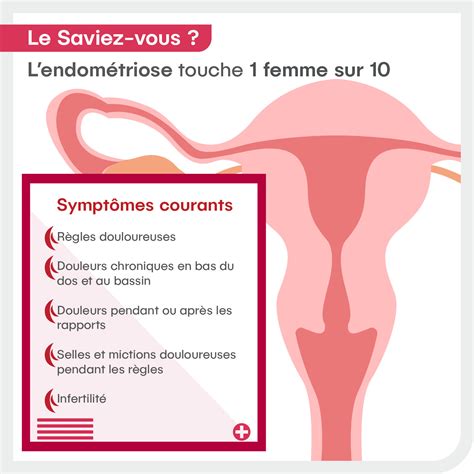 Lendométriose mieux la comprendre et la traiter