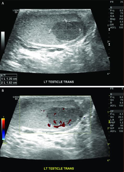 Representative Ultrasound Images Of The Testicular Mass A The Mass