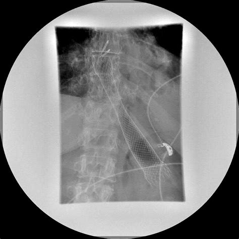 Delayed Esophageal Diverticulum Formation After Stent Based Treatment