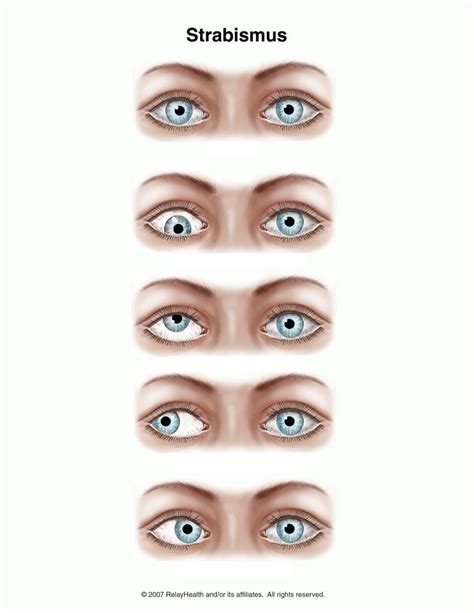 Table 11-7: Dysconjugate Gaze Diagram | Quizlet