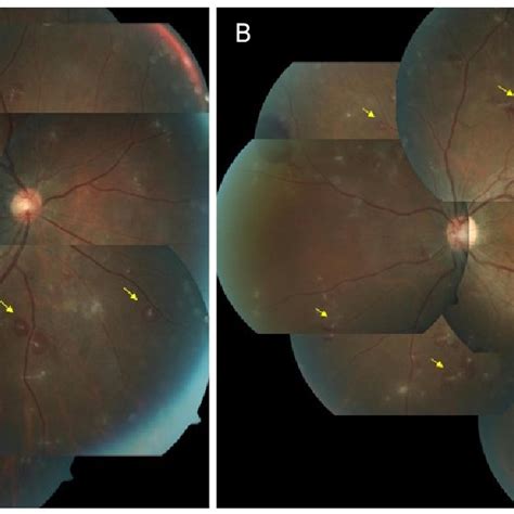 Color fundus photo of the second case. Right (A), left (B), both fundus ...