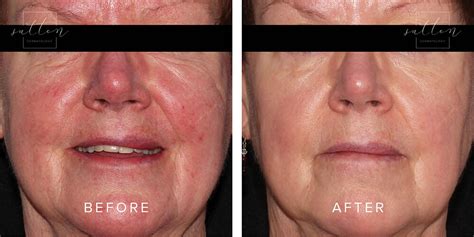 Rosacea Treatment Vancouver West Dermatology