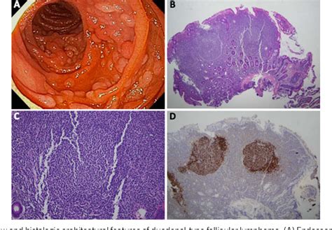 Figure From Incidental Finding Of A Duodenal Type Follicular Lymphoma