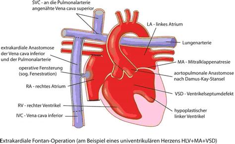 Univentrikul Res Herz Ukm Klinik F R Herz Und Thoraxchirurgie