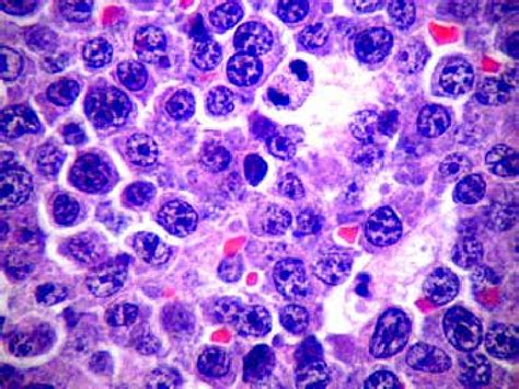 Plasmablastic Lymphoma Cells With A Plasmacytoid Appearence With A