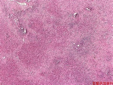 Kmu Pathology Labslide Actinomycosis Liver