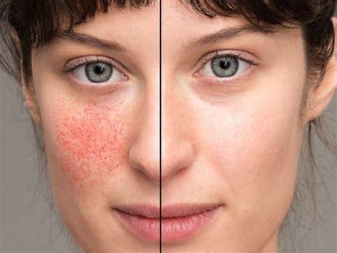 3 Ways To Clear Up Rosacea Fast Plantation Dermatology