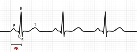 The Pr Interval Ecg Basics Medschool