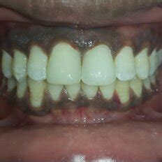 Postoperative View After The Diastema Closure With Direct Composite