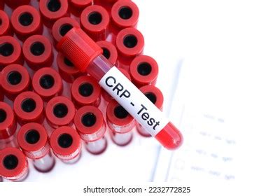 Crp Test Look Abnormalities Blood Blood Stock Photo 2232772825 | Shutterstock