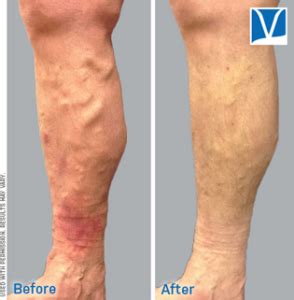 Can Varicose Veins Cause A Skin Rash Lower Leg Skin Rashes