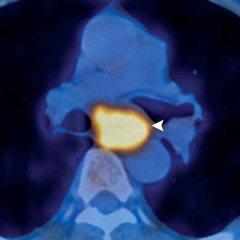 PET CT Of Esophageal Cancer Its Role In Clinical Management