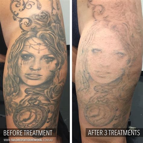 Before And Afters Tailored Tattoo Removal Melbourne