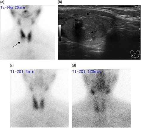 A A Tc 99m Scintigraphy Image Showing A Cold Thyroid Nodule Arrow In