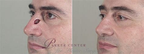 Skin Cancer Treatment Before And After Pictures Case 1083 Paramus Nj Parker Center For