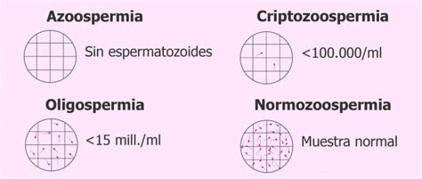 Concentración de espermatozoides en el seminograma