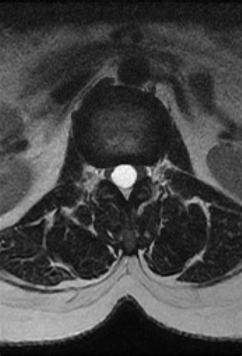 Spinal Ependymoma Image