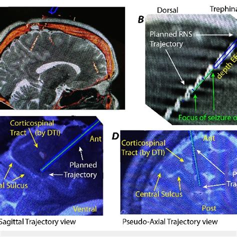 Stereotactic Planning A Sagittal Slice Through Fused Ct Mri