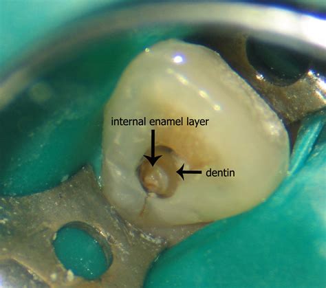 Dens Invaginatus Is Also Known As Dens In Dente Dental Student