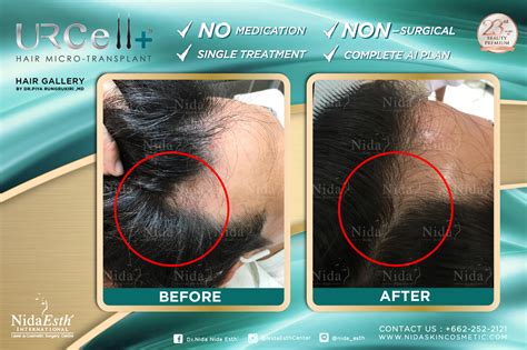 Bangkok Post Does Non Surgical Hair Transplant Work Behind Cosmetic