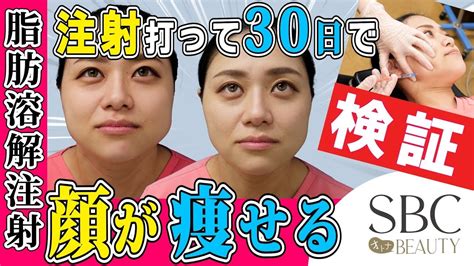 【小顔】脂肪溶解注射は金ドブか？本当に小顔になるか試しました【山参注射とエラボトックス】 Youtube