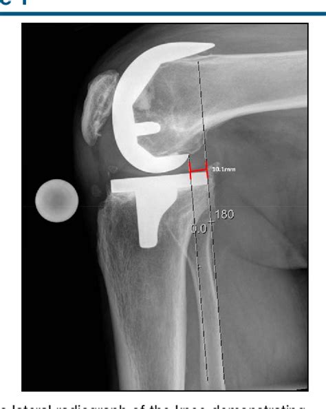 Figure 1 From Stress Radiograph Confirmation Of Translational