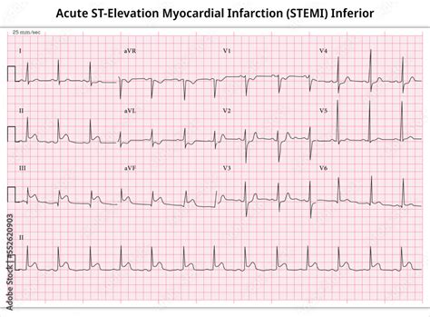 Photo & Art Print Acute ST-Elevation Myocardial Infarction (STEMI ...