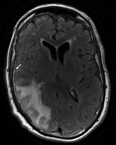 Cerebral Amyloid Angiopathy-related Inflammation | Applied Radiology