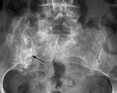 Imaging And Treatment Of Sacral Insufficiency Fractures American Journal Of Neuroradiology