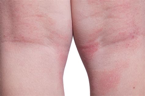 Eczema Reno Tahoe Dermatology Best Reno Dermatologist