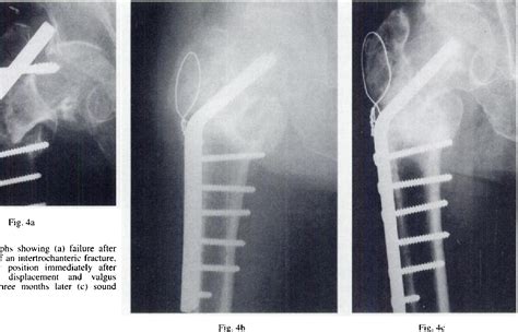 Figure 1 From Nonunion Of Intertrochanteric Fractures Of The Femur