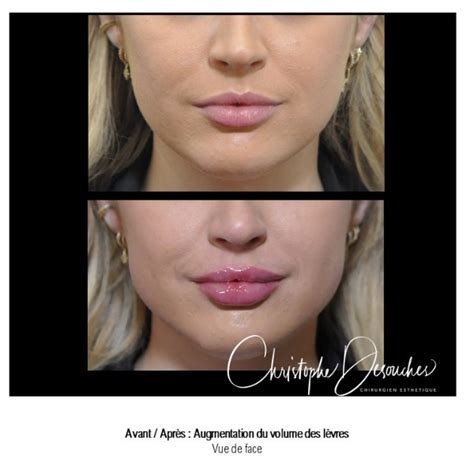 Lips Augmentation Augmentation Des Levres Par Injection D Acide