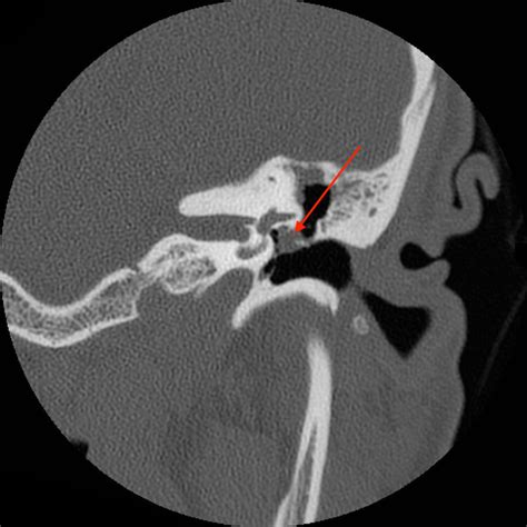 Cholesteatoma Chad Ruffin Md