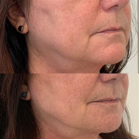 Jawline Gallery Nu Image Medical Esthetics