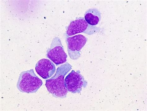 CML Lymphoid Blast Crisis With CNS Involvement