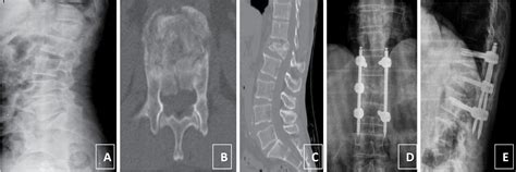 Scielo Brasil Percutaneous Instrumentation Without Arthrodesis For