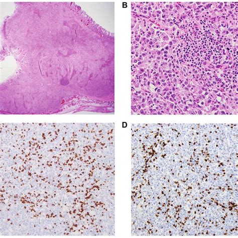 Histopathological Findings And Immunostaining Of Surgical Specimens