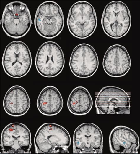 Regional Cortical Gray Matter Volume Increase Orangered And