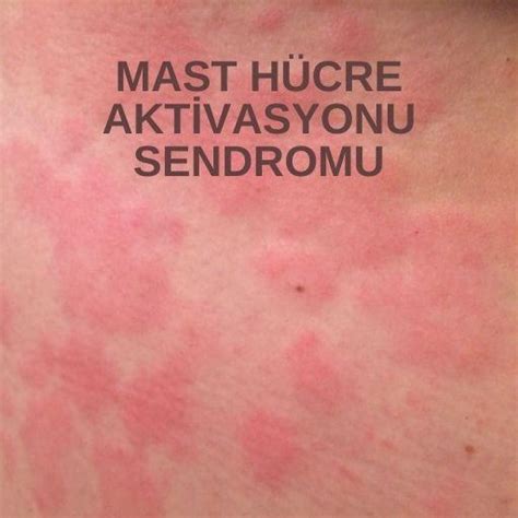 Mast H Cre Aktivasyonu Sendromu Prof Dr Nevrez Koylan