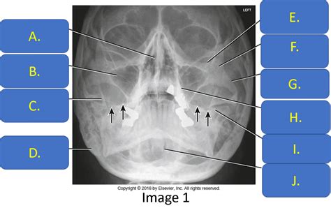 Facial Bones Anatomy Diagram | Quizlet