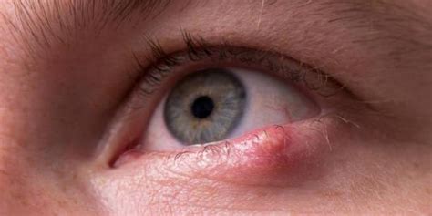 Home Remedies And Treatments For Styes Causes Symptoms And Solutions Archyde