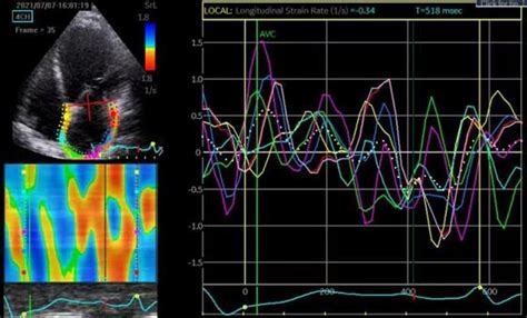 Measurement Of La Strain And Strain Rate In Apical Four Chamber View