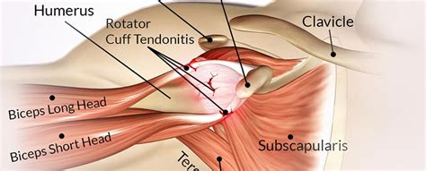 Rotator Cuff Tendonitis And Impingement Syndrome Treatment California