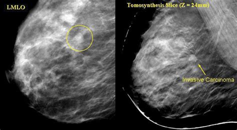 Digital Tomosynthesis 3d Mammography