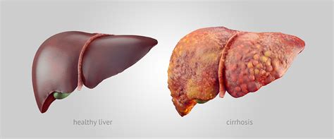 Cirrhosis Community Liver Alliance