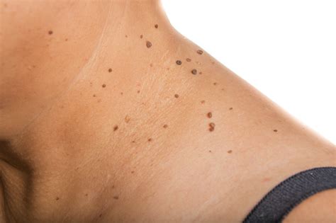 This Is What It Means If You Have A Mole At One Of These Places On Your