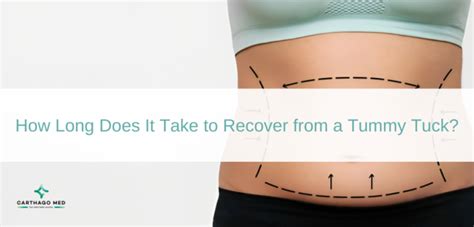 Understanding Tummy Tuck Recovery Timelines And Stages