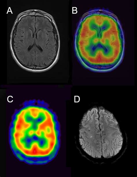 Irm C R Brale T Flair Initiale Et Scintigraphie De Perfusion C R Brale