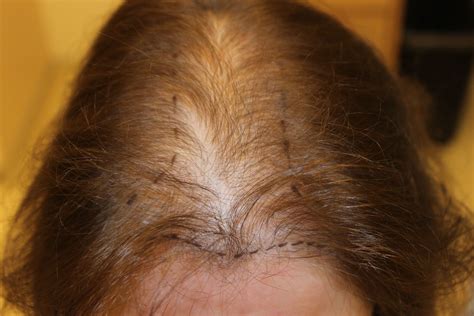 Telogen Effluvium Hair Loss Want Additional Info Click On The Image This Is An Amazon