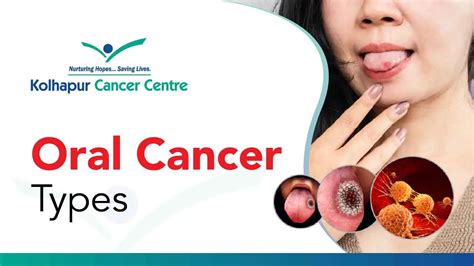 What Are The Different Types Of Oral Cancer Cancer Hospital In